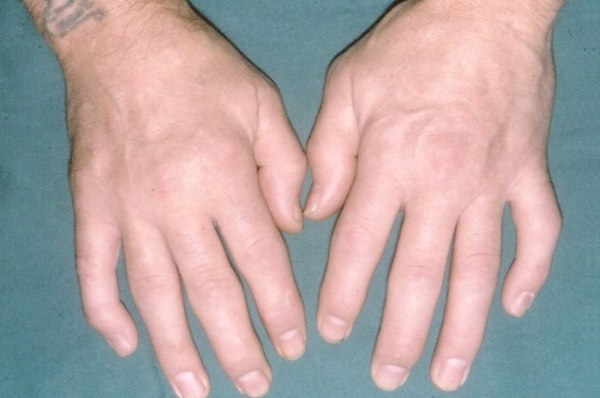 Reactive Arthritis Treatment